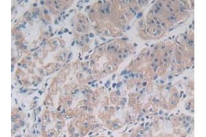 DAB staining on IHC-P; Samples: Human Breast cancer Tissue)