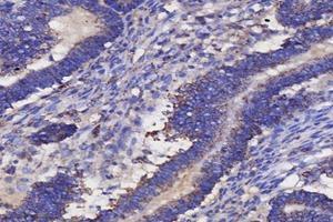 Immunohistochemistry analysis of paraffin-embedded human ovarian cancer using IL-3RB (ABIN7073557) at dilution of 1: 4000 (CD131 Antikörper)