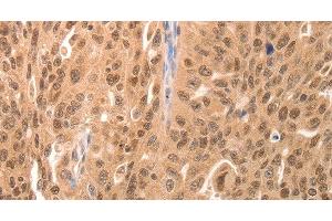 Immunohistochemistry of paraffin-embedded Human breast cancer tissue using JUND Polyclonal Antibody at dilution 1:60