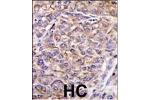 Formalin-fixed and paraffin-embedded human hepatocarcinoma tissue reacted with TAOK3 antibody (C-term) (ABIN390997 and ABIN2841175) , which was peroxidase-conjugated to the secondary antibody, followed by DAB staining. (TAO Kinase 3 Antikörper  (C-Term))