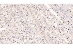 Detection of MBP in Human Liver cancer Tissue using Monoclonal Antibody to Major Basic Protein (MBP) (Major Basic Protein Antikörper  (AA 105-222))