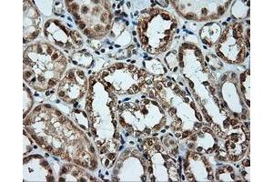 Immunohistochemical staining of paraffin-embedded Carcinoma of liver tissue using anti-LIPG mouse monoclonal antibody. (LIPG Antikörper)