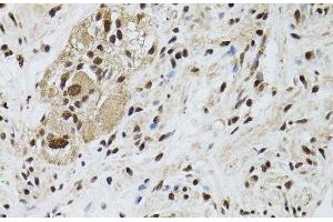 Immunohistochemistry of paraffin-embedded Human colon carcinoma using LKB1 Polyclonal Antibody at dilution of 1:100 (40x lens). (LKB1 Antikörper)