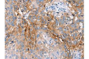 The image on the left is immunohistochemistry of paraffin-embedded Human lung cancer tissue using ABIN7130650(PLCZ1 Antibody) at dilution 1/25, on the right is treated with fusion protein. (PLCz1 Antikörper)