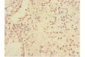 Immunohistochemistry of paraffin-embedded human breast cancer using ABIN7170630 at dilution of 1:100 (Splicing factor U2AF 26 kDa subunit (U2AF1L4) (AA 1-202) Antikörper)