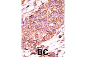 Formalin-fixed and paraffin-embedded human cancer tissue reacted with the primary antibody, which was peroxidase-conjugated to the secondary antibody, followed by AEC staining.