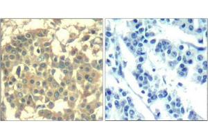 Immunohistochemical analysis of paraffin-embedded human breast carcinoma tissue using Met(Ab-1003) Antibody(left) or the same antibody preincubated with blocking peptide(right). (c-MET Antikörper  (AA 1001-1005))