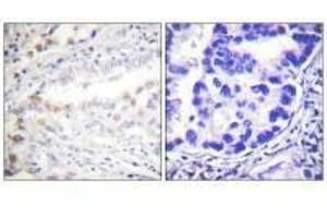 Immunohistochemistry analysis of paraffin-embedded human lung carcinoma tissue using Uba2 antibody. (UBA2 Antikörper  (C-Term))