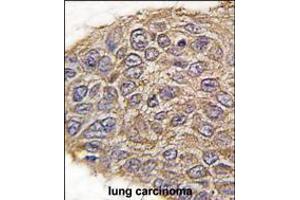 Formalin-fixed and paraffin-embedded human lung carcinoma tissue reacted with ALDOA antibody , which was peroxidase-conjugated to the secondary antibody, followed by DAB staining.