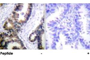 Immunohistochemical analysis of paraffin-embedded human lung carcinoma tissue using DUSP1 polyclonal antibody .