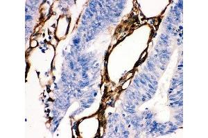 IHC-P: HSP27 antibody testing of human intestine cancer tissue (HSP27 Antikörper  (AA 1-205))