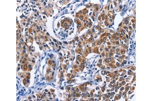 Immunohistochemistry of Human breast cancer using MYH1 Polyclonal Antibody at dilution of 1:40 (MYH1 Antikörper)