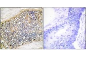 Immunohistochemistry analysis of paraffin-embedded human colon carcinoma tissue, using TALL-2 Antibody. (TNFSF13 Antikörper  (AA 151-200))