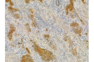ABIN6258127 and ABIN6275841 at 1/100 staining human esophageal carcinoma by IHC-P. (DRAK2 Antikörper  (C-Term))