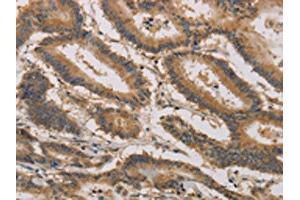 The image on the left is immunohistochemistry of paraffin-embedded Human colon cancer tissue using ABIN7190296(CLEC5A Antibody) at dilution 1/20, on the right is treated with synthetic peptide. (CLEC5A Antikörper)