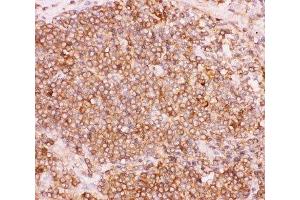 IHC-P: NFKB2 antibody testing of human lung cancer tissue (NFKB2 Antikörper  (AA 1-340))