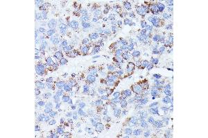 Immunohistochemistry of paraffin-embedded human liver cancer using CCDC6 antibody (ABIN7266442) at dilution of 1:100 (40x lens). (CCDC6 Antikörper  (AA 55-222))