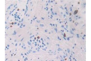 DAB staining on IHC-P; Samples: Human Lung cancer Tissue (CCL26 Antikörper  (AA 24-94))