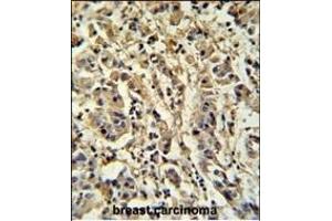 Sirt3 Antibody (C-term) (ABIN652184 and ABIN2840670) IHC analysis in formalin fixed and paraffin embedded human breast carcinoma followed by peroxidase conjugation of the secondary antibody and DAB staining. (SIRT3 Antikörper  (C-Term))