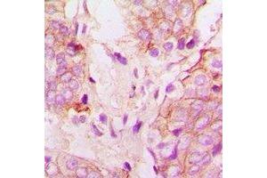 Immunohistochemical analysis of Cytochrome P450 51A1 staining in human prostate cancer formalin fixed paraffin embedded tissue section. (CYP51A1 Antikörper)