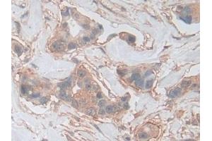 Detection of PKBg in Human Breast cancer Tissue using Polyclonal Antibody to Protein Kinase B Gamma (PKBg) (AKT3 Antikörper  (AA 46-338))