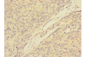Immunohistochemistry of paraffin-embedded human ovarian cancer using ABIN7144788 at dilution of 1:100 (Ataxin 1 Antikörper  (AA 346-475))