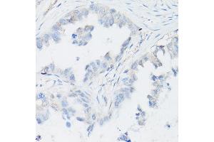 Immunohistochemistry of paraffin-embedded Human lung adenocarcinoma (negative control sample) using p63 Rabbit mAb (ABIN7271099) at dilution of 1:100 (40x lens). (p63 Antikörper)