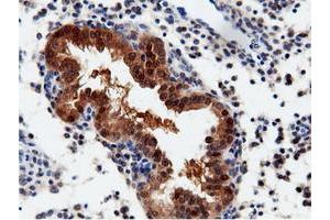 Immunohistochemical staining of paraffin-embedded Adenocarcinoma of Human endometrium tissue using anti-QPRT mouse monoclonal antibody. (QPRT Antikörper)