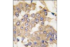 Formalin-fixed and paraffin-embedded human breast carcinoma tissue reacted with ERK2 antibody (C-term), which was peroxidase-conjugated to the secondary antibody, followed by DAB staining. (ERK2 Antikörper  (C-Term))