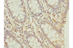 Immunohistochemistry of paraffin-embedded human colon cancer using ABIN7164341 at dilution of 1:100 (DDX2 (AA 25-280) Antikörper)