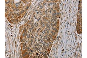 The image on the left is immunohistochemistry of paraffin-embedded Human esophagus cancer tissue using ABIN7130527(PAGE2 Antibody) at dilution 1/20, on the right is treated with fusion protein. (PAGE2 Antikörper)