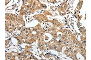 The image on the left is immunohistochemistry of paraffin-embedded Human lung cancer tissue using ABIN7192673(STEAP4 Antibody) at dilution 1/25, on the right is treated with synthetic peptide. (STEAP4 Antikörper)