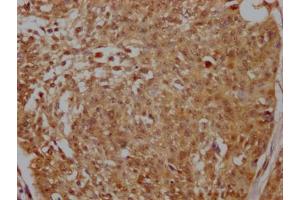 IHC image of ABIN7127675 diluted at 1:100 and staining in paraffin-embedded human cervical cancer performed on a Leica BondTM system. (Rekombinanter PELP1 Antikörper)
