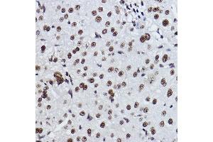 Immunohistochemistry of paraffin-embedded human liver cancer using EXOSC7 Rabbit mAb (ABIN7267064) at dilution of 1:100 (40x lens). (EXOSC7 Antikörper)