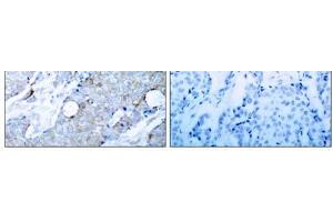 Immunohistochemical analysis of paraffin-embedded human breast carcinoma tissue using V (VEGFR2/CD309 Antikörper)