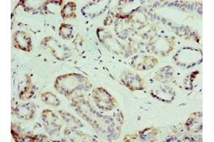 Immunohistochemistry of paraffin-embedded human breast cancer using ABIN7176713 at dilution of 1:100 (SLC39A6 Antikörper  (AA 170-320))