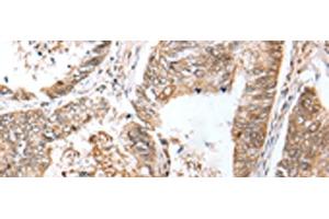 Immunohistochemistry of paraffin-embedded Human colorectal cancer tissue using LRRC19 Polyclonal Antibody at dilution of 1:30(x200)