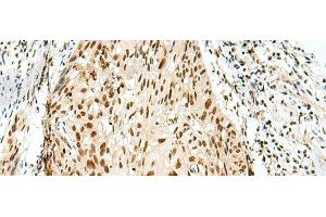 Immunohistochemistry of paraffin-embedded Human esophagus cancer tissue using RBM10 Polyclonal Antibody at dilution of 1:55(x200)