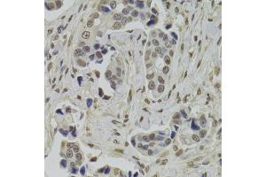 Immunohistochemistry of paraffin-embedded human breast cancer using INTS6 Antibody.