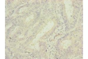 Immunohistochemistry of paraffin-embedded human endometrial cancer using ABIN7142279 at dilution of 1:100 (MRPS6 Antikörper  (AA 1-125))