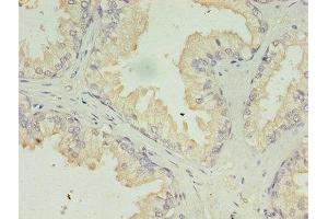 Immunohistochemistry of paraffin-embedded human prostate cancer using ABIN7142322 at dilution of 1:100 (ACAA1 Antikörper  (AA 27-331))