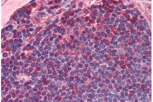 Human Colon, MALT (formalin-fixed, paraffin-embedded) stained with IL7R antibody ABIN351552 at 5 ug/ml followed by biotinylated goat anti-rabbit IgG secondary antibody ABIN481713, alkaline phosphatase-streptavidin and chromogen. (IL7R Antikörper  (C-Term))