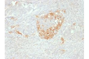 Formalin-fixed, paraffin-embedded human Neuroendocrine tumor stained with NSE gamma Mouse Monoclonal Antibody (NSE-P2). (ENO2/NSE Antikörper  (AA 416-433))