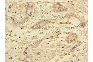 Immunohistochemistry of paraffin-embedded human pancreatic cancer using ABIN7169312 at dilution of 1:100 (PPP1CC Antikörper  (Catalytic Subunit))