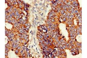 Immunohistochemistry of paraffin-embedded human colon cancer using ABIN7144717 at dilution of 1:100 (Asparagine Synthetase Antikörper  (AA 364-551))
