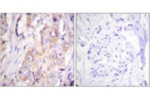 Immunohistochemistry analysis of paraffin-embedded human breast carcinoma, using MEK1 (Phospho-Thr286) Antibody. (MEK1 Antikörper  (pThr286))