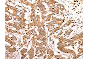 The image on the left is immunohistochemistry of paraffin-embedded Human colon cancer tissue using ABIN7190209(CELSR2 Antibody) at dilution 1/50, on the right is treated with synthetic peptide. (CELSR2 Antikörper)