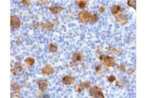 IHC testing of FFPE human Hodgkin's lymphoma with recombinant CD30 antibody (clone CDLA30-2R).