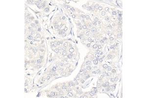 Immunohistochemistry of paraffin-embedded Human triple negative breast cancer (negative control sample) using Progesterone Receptor Rabbit mAb (ABIN7269533) at dilution of 1:100 (40x lens). (Progesterone Receptor Antikörper)