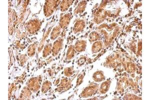 IHC-P Image BCL2L12 antibody detects BCL2L12 protein at cytosol and nucleus on human colon carcinoma by immunohistochemical analysis. (BCL2L12 Antikörper  (C-Term))